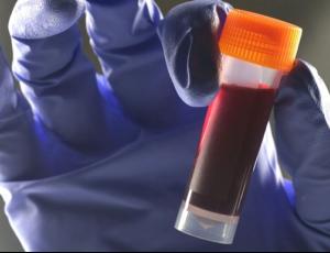 Учёные обнаружили связь между группой крови и риском диабета 2 типа